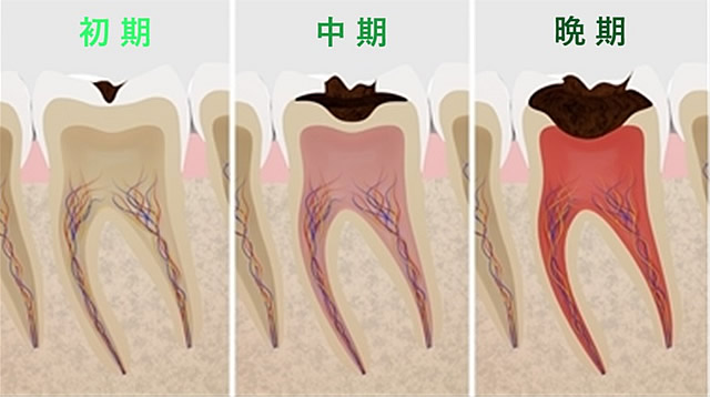 むし歯の治療