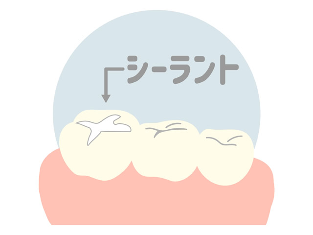 シーラント