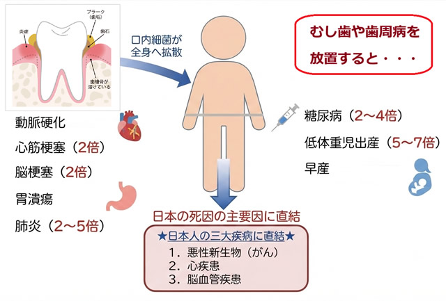 お口の中の健康と全身疾患の関係